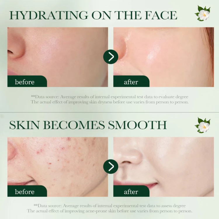 کرم ضد آکنه سادور SADOER ACNE CREAM